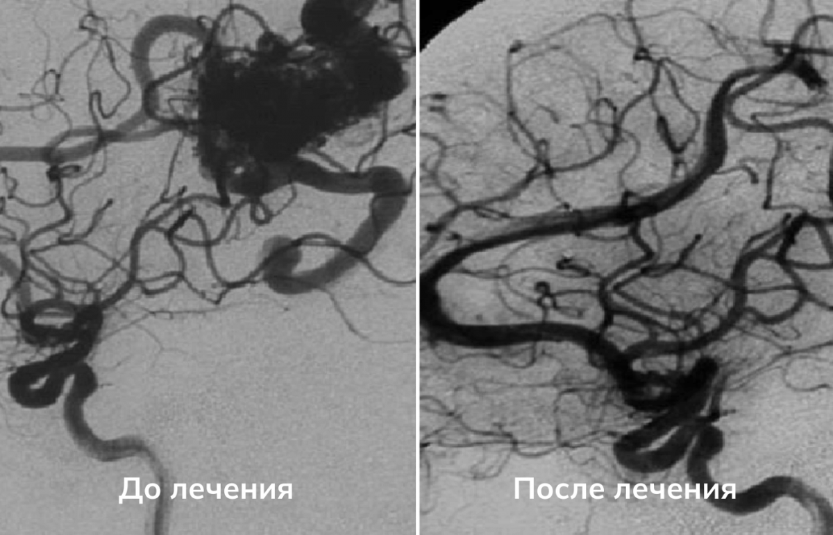 Препарат новосибирских ученых предотвратит разрыв сосудов | Новости науки